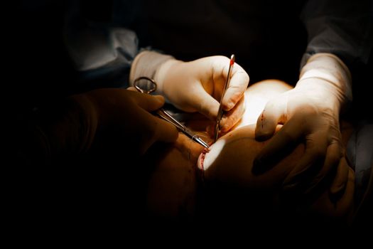 Surgeon surgeon sutures chest of woman after operation. Tits augmentation plastic operation and correction in medical clinic