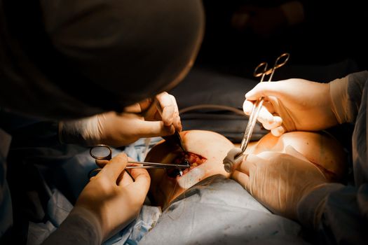 Surgeon surgeon sutures chest of woman after operation. Tits augmentation plastic operation and correction in medical clinic