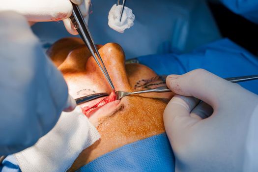 Upper blepharoplasty. Surgeon do plastic operation. 2 surgeons removing piece of skin from eyelid. Transconjunctival blepharoplasty. Surgery.