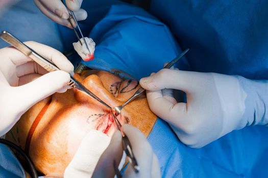 Transconjunctival blepharoplasty. Surgery. Upper blepharoplasty. Surgeon do plastic operation. 2 surgeons removing piece of skin from eyelid