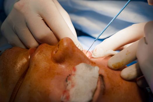 Upper blepharoplasty. Surgeon do plastic operation. 2 surgeons removing piece of skin from eyelid. Transconjunctival blepharoplasty. Surgery.