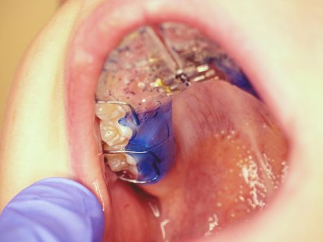 Teeth with braces at reception at dentist. Close-up. Hand in glove with a tool at the patients teeth.