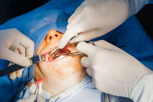 Buccal fat removal. Bisha lumps removal. Plastic surgery in clinic. Plastic surgery operation for modifying face in medical clinic.