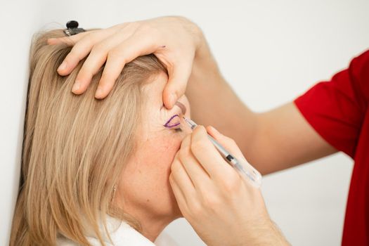 Blepharoplasty markup close-up on the face before the plastic surgery operation for modifying the eye region of the face in medical clinic. Doctor doing plastic cosmetic operation