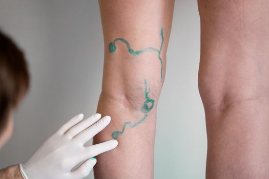 Vein markup. Vascular surgeon is marking veins for varicose surgery.