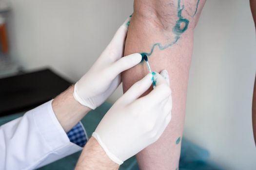 Vein markup. Vascular surgeon is marking veins for varicose surgery.