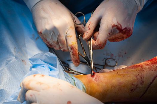 Vascular surgeon is removing veins for varicose surgery