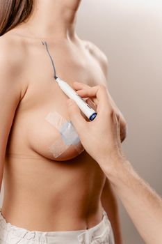 Breast augmentation surgery markup. Preparation for plastic surgery for introduction of silicone implant