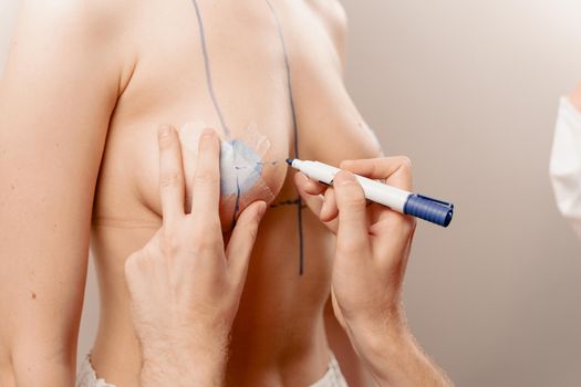 Doctor draws lines on chest with marker before plastic surgery. Breast augmentation surgery markup