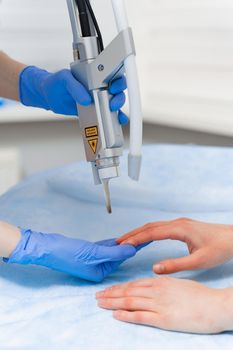 Laser treatment of onychomycosis. fungal infection on the hands of a young girl in medical clinic.