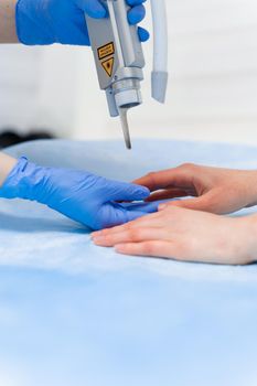 Laser treatment of onychomycosis. fungal infection on the hands of a young girl in medical clinic.