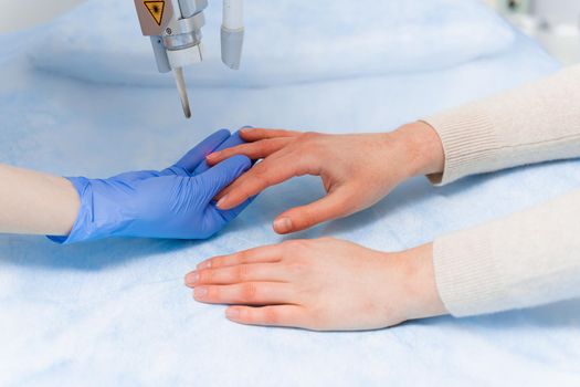 Laser treatment of onychomycosis. fungal infection on the hands of a young girl in medical clinic.