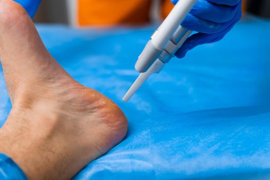 Laser removal of warts on the foot. Medical dermatological surgery in the clinic.