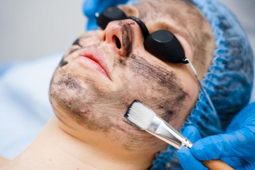 Dermatologist smears black mask on face for laser photorejuvenation and carbon peeling. Dermatology and cosmetology. Using surgical laser.