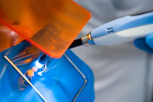 Dental treatment cofferdam in stomatology. Dentist using dental dam for tooth isolation