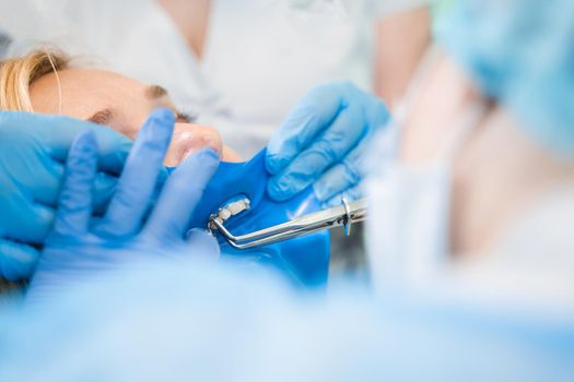 Dental treatment cofferdam in stomatology. Dentist using dental dam for tooth isolation