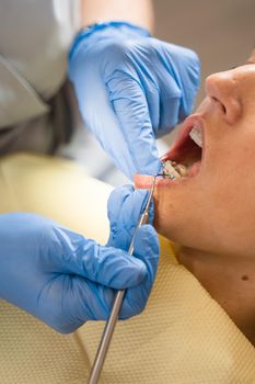 Teeth straightening braces stomatology procedure. Dentist removes brackets