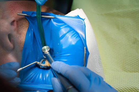 Dental treatment cofferdam in stomatology. Dentist using dental dam for tooth isolation