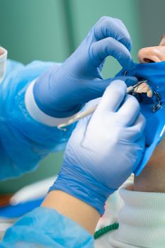 Dental treatment cofferdam in stomatology. Dentist using dental dam for tooth isolation