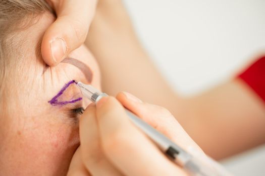 Blepharoplasty markup close-up on the face before the plastic surgery operation for modifying the eye region of the face in medical clinic. Doctor doing plastic cosmetic operation