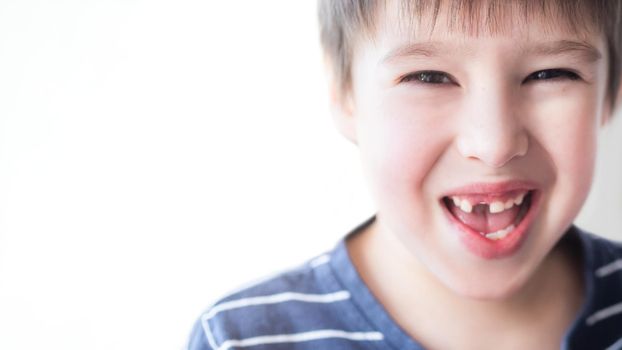 Smiling kid shows hole in row of teeth in his mouth. One incisor fell out just now. Close up photo of gums for dentist. Copy space.