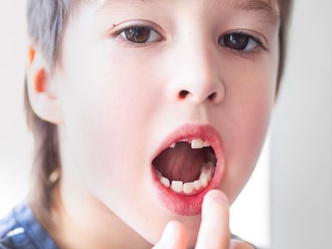 Little kid shows hole in row of teeth in his mouth. One incisor fell out just now. Close up photo of gums for dentist.