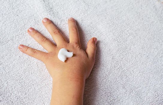 Red spots on the skin of the child's hands.children's allergy.selective focus.nature