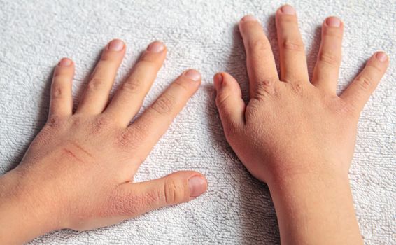 Red spots on the skin of the child's hands.children's allergy.selective focus.nature