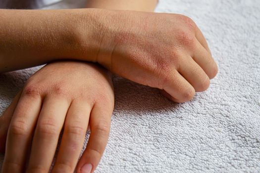 Red spots on the skin of the child's hands.children's allergy.selective focus.nature