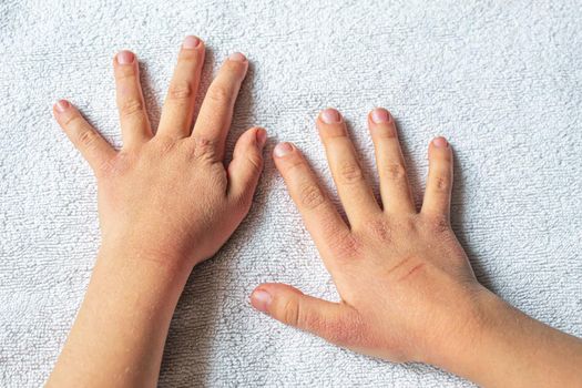 Red spots on the skin of the child's hands.children's allergy.selective focus.nature