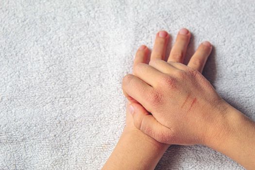 Red spots on the skin of the child's hands.children's allergy.selective focus.nature