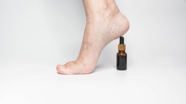 Feet with dry skin before oil treatment. Woman foot with an esential oil bottle as a heel. White background