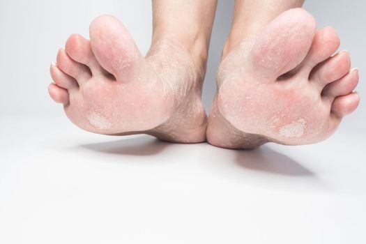 Close-up view female sore skin of feet, dry heels isolated on a white background