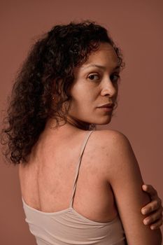 Close up portrait on colored background with copy space of a pretty woman in beige top hugging herself looking at the camera showing skin problems on her back. Dermatology, body positive