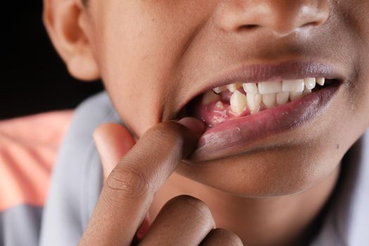 child with a tooth dropped out.