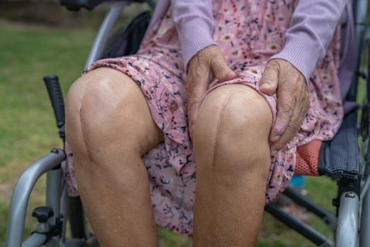 Asian senior or elderly old lady woman patient show her scars surgical total knee joint replacement Suture wound surgery arthroplasty on bed in nursing hospital ward, healthy strong medical concept.