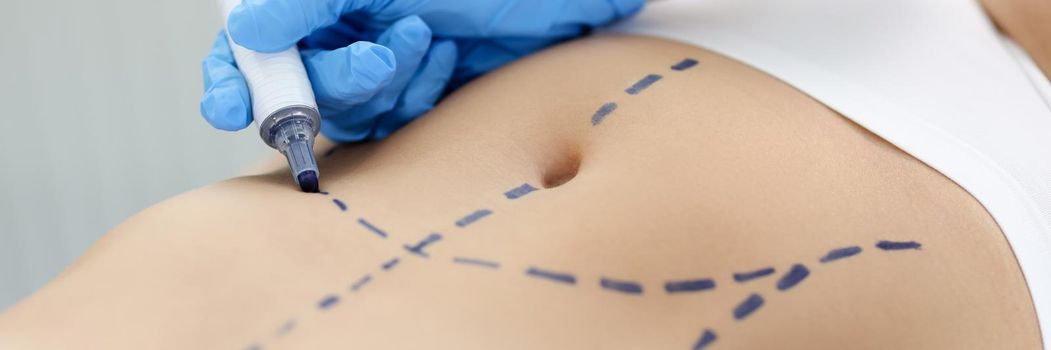 Doctor drawing preoperative marking on patient abdomen closeup. Plastic surgery liposuction concept