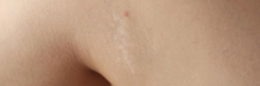 An inflamed pimple on the leg, close-up, shugaring. Skin irritation, dermatologist visit, problem skin