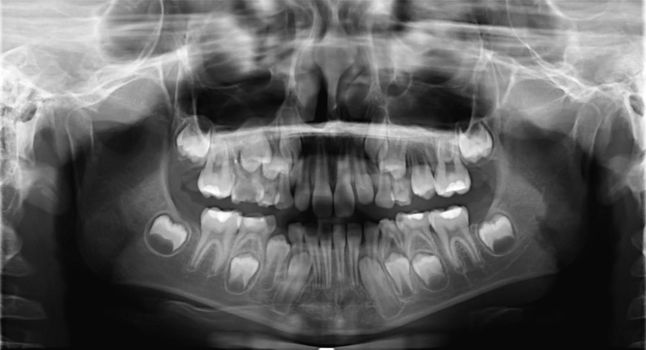X-ray scan of children's jaw teeth. Panoramic negative image of the face of the child. The picture was taken for a dental diagnostic examination at a clinical examination.