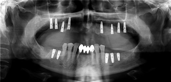 A macro shot of dental implant in the oral cavity and its Panoramic dental X-Ray