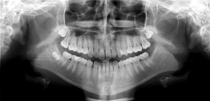 Original black white x-ray teeth scan mandible. Panoramic negative image facial of young adult male. Photo was taken on digital system equipment for dental diagnostic examination upon clinical checkup