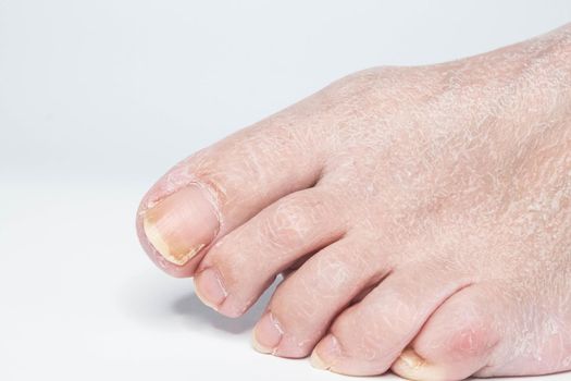 Close-up view female sore skin of feet, dry heels isolated on a white background