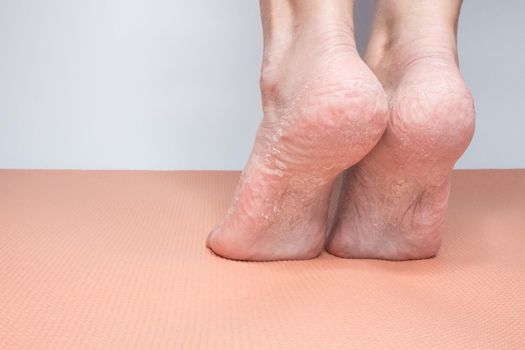 Close-up view female sore skin of feet, dry heels isolated on a white background