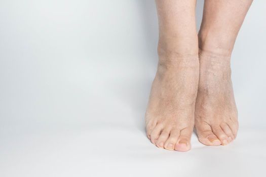 Close-up view female sore skin of feet, dry heels isolated on a white background