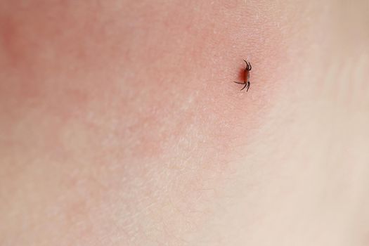 Dangerous insect tick. Ixodes ricinus tick sucking on human skin. A bloated parasite has bitten a man. Pink irritated epidermis. Encephalitis infection, Lyme disease. Selectiv focus