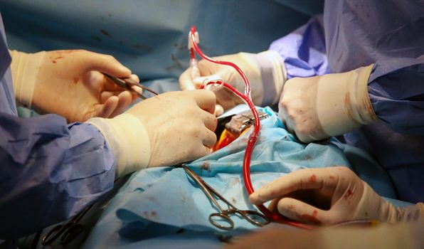 We work with a valve. Valve Replacement. Heart surgery.