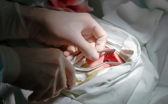 The actual operation to install a pacemaker, incision.