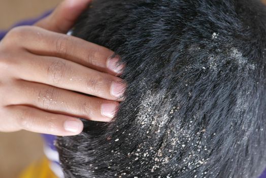 men with dandruff in his hair, closeup .