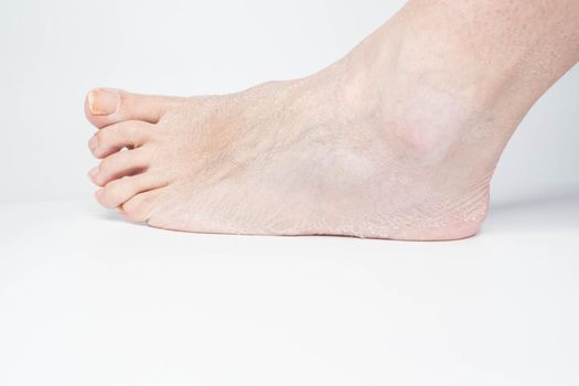 Close-up view female sore skin of feet, dry heels isolated on a white background