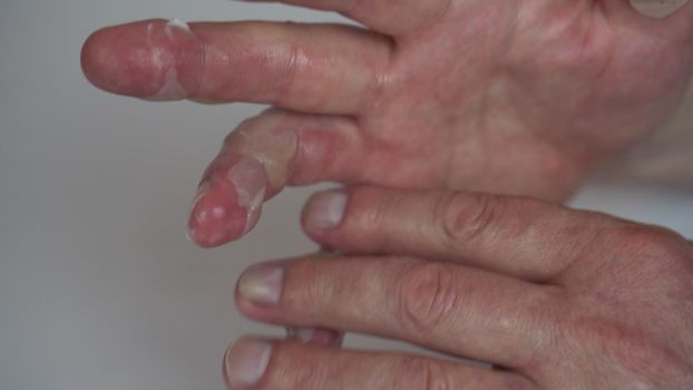 A man smeared ointment on his hand with a second-degree hot water burn. The skin is swollen with blisters. 4k